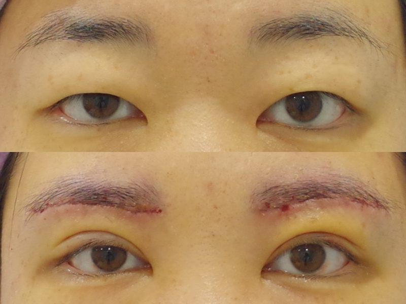 二重手術に眉下切開を併用して劇的変化 京都の美容外科 美容皮膚科 烏丸御池ビューティークリニック