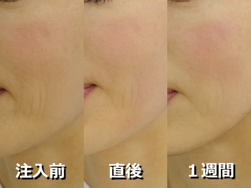 皮膚の浅いしわに対しては柔らかいヒアルロン酸で 京都の美容外科 美容皮膚科 烏丸御池ビューティークリニック