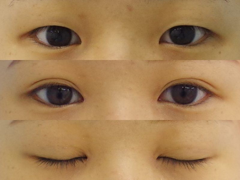 蒙古ひだが強めの方は 目頭切開の併用がおススメです 京都の美容外科 美容皮膚科 烏丸御池ビューティークリニック