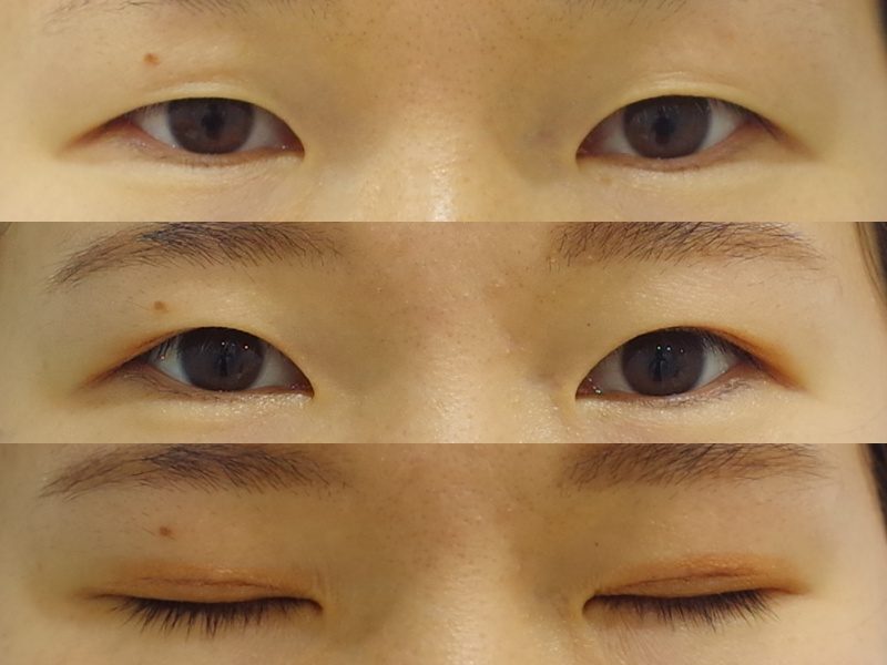 奥二重のような自然な二重を全切開で作ってみましょう 京都の美容外科 美容皮膚科 烏丸御池ビューティークリニック