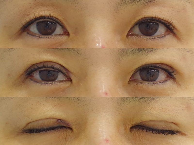 たるみの強い皮膚ですが 埋没法で目が開けやすくなりました 京都の美容外科 美容皮膚科 烏丸御池ビューティークリニック
