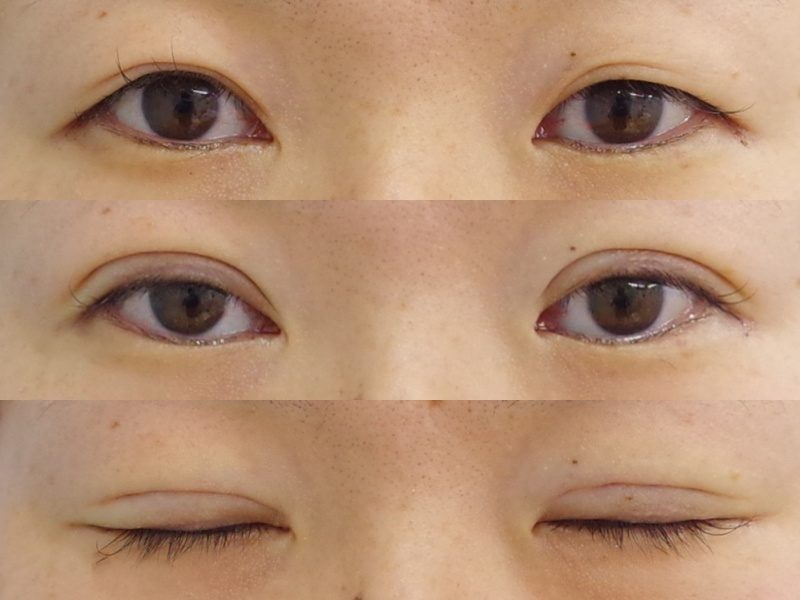 以前埋没法で取れてしまった方でもご相談ください 京都の美容外科 美容皮膚科 烏丸御池ビューティークリニック