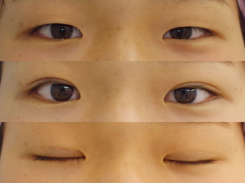 10代の若い方には できるだけ自然な二重をデザインするのがよいですッッ 京都の美容外科 美容皮膚科 烏丸御池ビューティークリニック 10代の若い方には できるだけ自然な二重をデザインするのがよいですッッ 京都の美容外科 美容皮膚科 烏丸御池ビューティークリニック