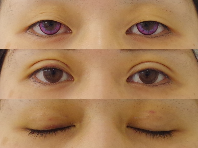 できるだけ幅の広い二重をご希望の場合 京都の美容外科 美容皮膚科 烏丸御池ビューティークリニック