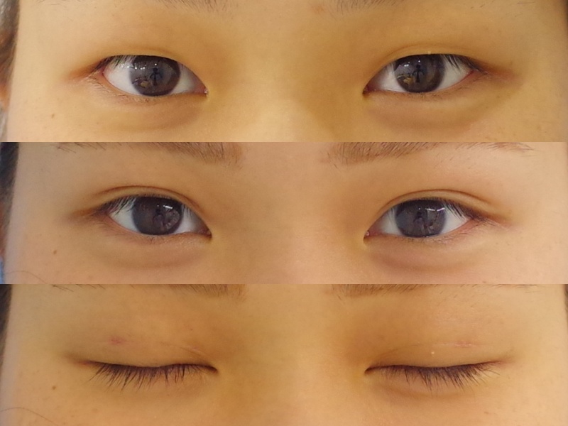 埋没法に脂肪取りを併用してきれいな平行型になりましたッッ 京都の美容外科 美容皮膚科 烏丸御池ビューティークリニック