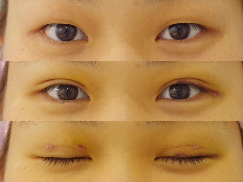 埋没法に脂肪取りを併用してきれいな平行型になりましたッッ 京都の美容外科 美容皮膚科 烏丸御池ビューティークリニック