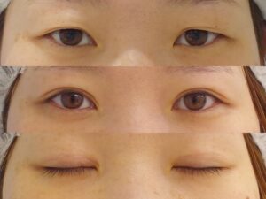全切開二重手術の術前、術後６カ月の経過写真