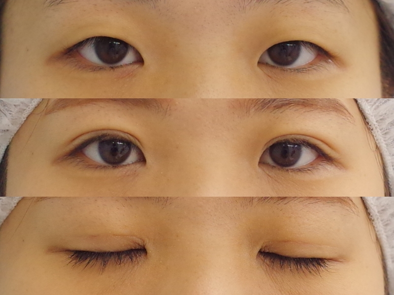 蒙古ひだがかなり強い方に平行型を作るッッ 京都の美容外科 美容皮膚科 烏丸御池ビューティークリニック