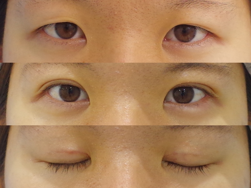 埋没だけでもこれだけ目が大きくなりました 京都の美容外科 美容皮膚科 烏丸御池ビューティークリニック
