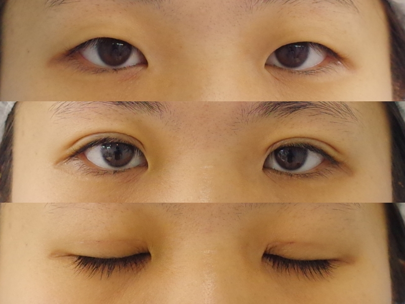 蒙古ひだがかなり強い方に平行型を作るッッ 京都の美容外科 美容皮膚科 烏丸御池ビューティークリニック