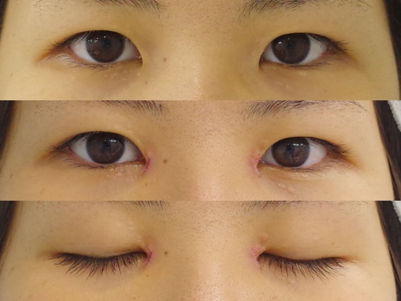 目頭切開で ナチュラルに離れ目感を改善しましょう 京都の美容外科 美容皮膚科 烏丸御池ビューティークリニック