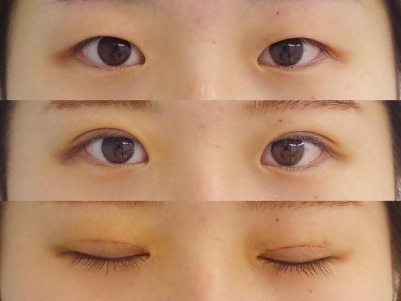 まつ毛の生え際が見えるようになるだけでこれだけ変わります 京都の美容外科 美容皮膚科 烏丸御池ビューティークリニック