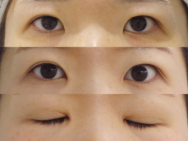 目頭切開 京都の美容外科 美容皮膚科 烏丸御池ビューティークリニック