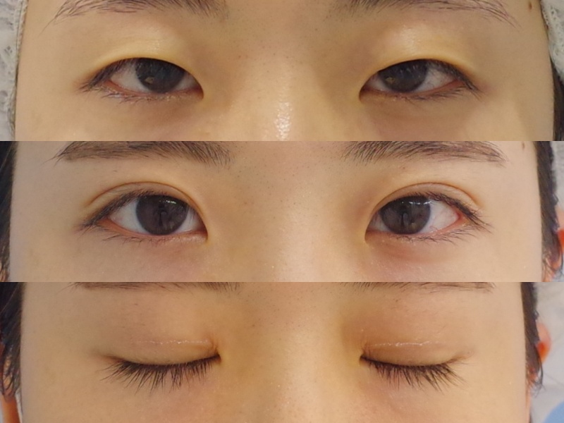 蒙古ひだが強く重たい印象の一重まぶたが 埋没で激変ッッ 京都の美容外科 美容皮膚科 烏丸御池ビューティークリニック