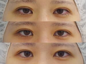 二重埋没法の術直後、術後１週間、術後１か月の経過写真