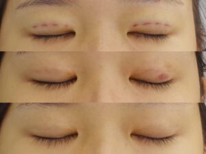 二重埋没法の術直後、術後１週間、術後１か月の目を閉じた状態の経過写真